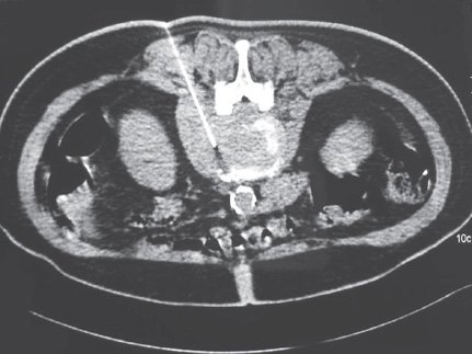 FNAC (Superficial Lesions)