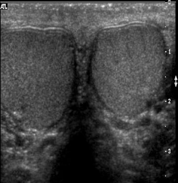 USG Breast / USG Scrotum